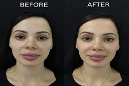 Results of Cosmetic Injectables clinic Dubai