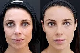 Results of Cosmetic Injectables Dubai,