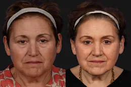 Results of Cosmetic Injectables clinic Dubai