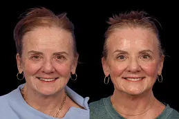 Results of Cosmetic Injectables clinic in Dubai