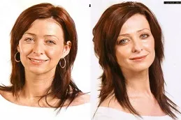 Results of Cosmetic Injectables in Dubai