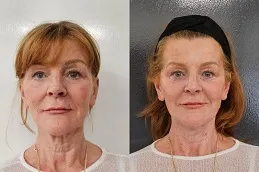 Results of Cosmetic Injectables in Dubai,