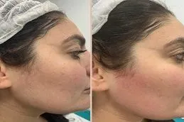 Results of Laser Treatments in Dubai.