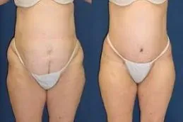 Pubic Lift Surgery Before & After Dubai