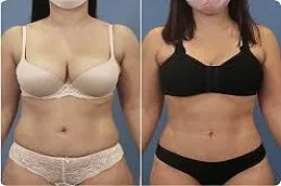 Pubic Lift Surgery Before & After Dubai,