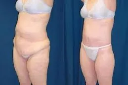 Pubic Lift Surgery Before & After clinic Dubai