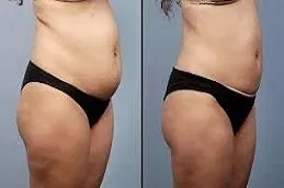 Pubic Lift Surgery Before & After clinic in Dubai,