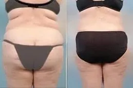 Pubic Lift Surgery Before & After