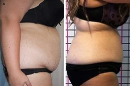 Results OF Lipolytic Injections For Belly Fat Dubai & Abu Dhabi