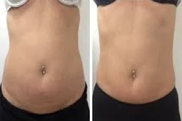 Results OF Lipolytic Injections For Belly Fat Dubai