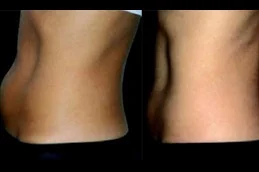 Results OF Lipolytic Injections For Belly Fat clinic Dubai