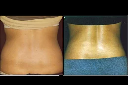 Results OF Lipolytic Injections For Belly Fat clinic in Dubai