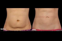 Results OF Lipolytic Injections For Belly Fat in Dubai & Abu Dhabi