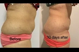 Results OF Lipolytic Injections For Belly Fat in Dubai