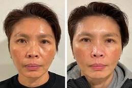 Results OF Salmon DNA Skin Boosters Treatment clinic Dubai