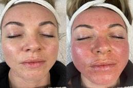 Results OF Salmon DNA Skin Boosters Treatment clinic in Dubai