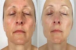 Results OF Salmon DNA Skin Boosters Treatment in Dubai