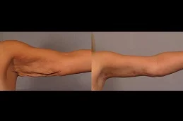 Results of Arm Lift Surgery Dubai