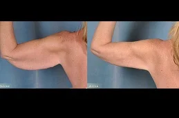 Results of Arm Lift Surgery clinic Dubai & Abu Dhabi