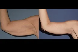 Results of Arm Lift Surgery clinic in Dubai & Abu Dhabi