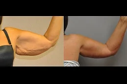 Results of Arm Lift Surgery in Dubai & Abu Dhabi.
