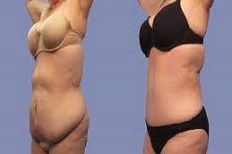 Results of Pubic Lift Surgery in Dubai