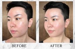 Salmon DNA Skin Boosters Treatment before & After Dubai