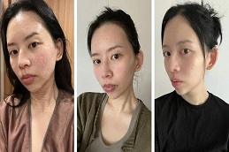 Salmon DNA Skin Boosters Treatment before & After in Dubai