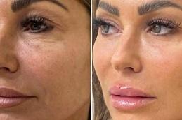 Polynucleotides Treatment Before & After Dubai