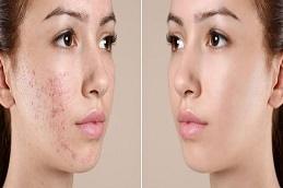 Polynucleotides Treatment Before & After in Dubai
