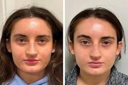 Polynucleotides Treatment Before & After