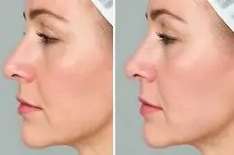 Results of Polynucleotide Clinic Dubai