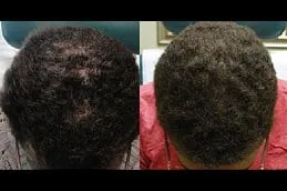 Regenera Activa Before & After Dubai,