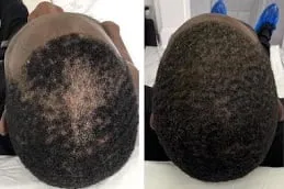 Regenera Activa Before & After in Dubai