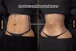 Results OF Dr. Pavan Murdeshwar Liposuction Dubai