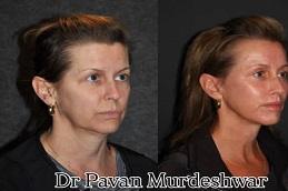 Results OF Dr. Pavan Murdeshwar Rhinoplasty Dubai