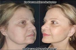 Results OF Dr. Pavan Murdeshwar Rhinoplasty Dubai
