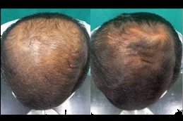 Results of Regenera Activa Dubai