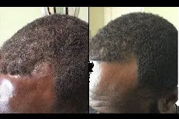 Results of Regenera Activa Dubai,