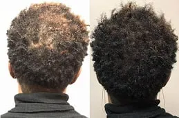 Results of Regenera Activa clinic in Dubai