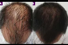 Results of Regenera Activa in Dubai