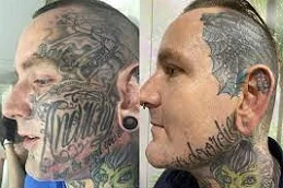 Results of Tattoo Removal Dubai