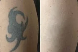 Results of Tattoo Removal clinic Dubai