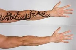 Results of Tattoo Removal in Dubai